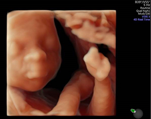20-week ultrasound