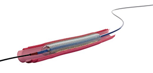 AGENT DCB placement in artery