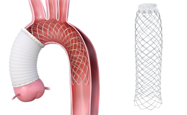 AMDS Hybrid Prosthetic device for aortic dissection treatment