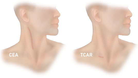 TCAR vs CEA procedure scars