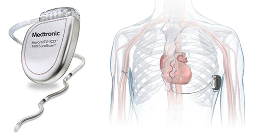 Medtronic EV-ICD device for heart disease