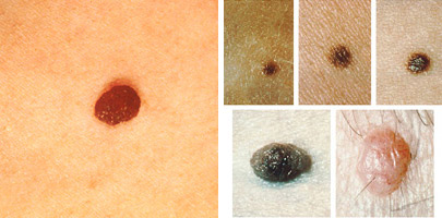 Moles with normal appearance