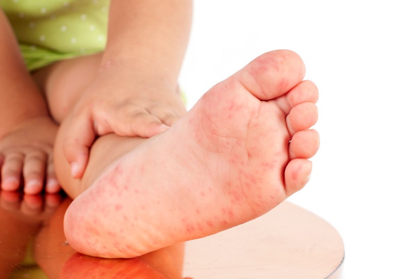 Red rash on child's foot