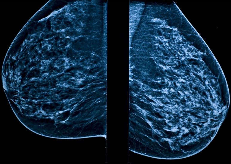 3D mammogram diagnostic image