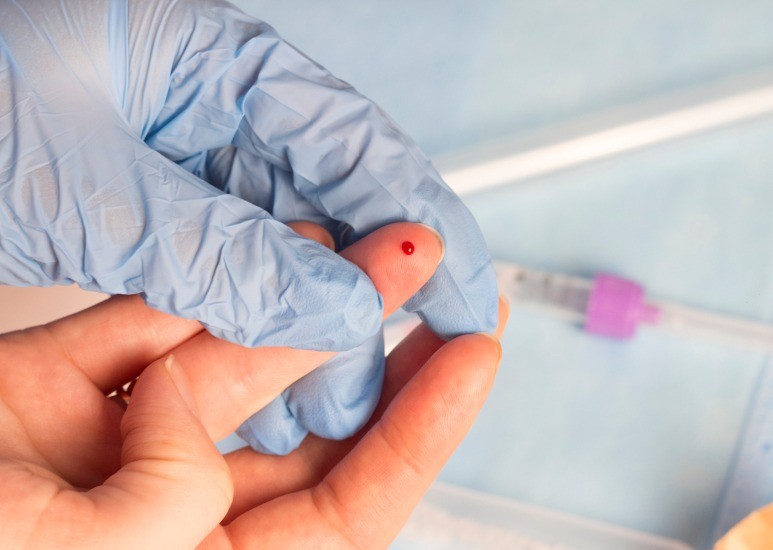 Finger prick HIV blood test 