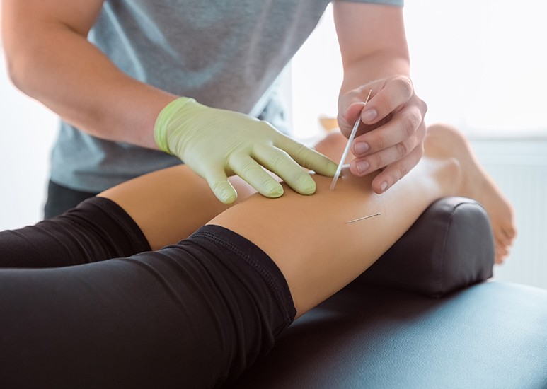 Acupuncturist inserting needles