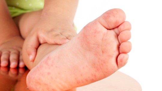 Red rash on child's foot