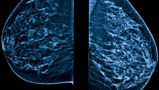 3D mammogram diagnostic image