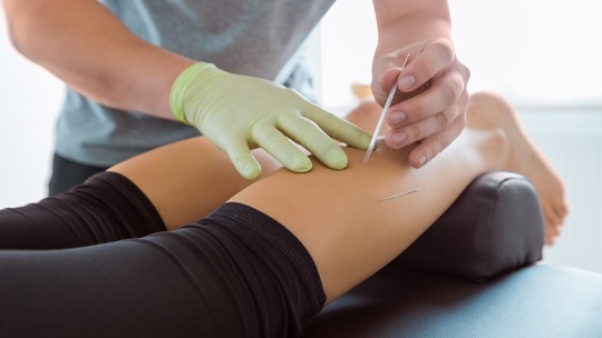 Acupuncturist inserting needles