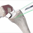 Mako knee replacement preparation